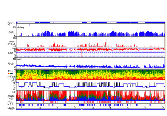 polysomnographie
